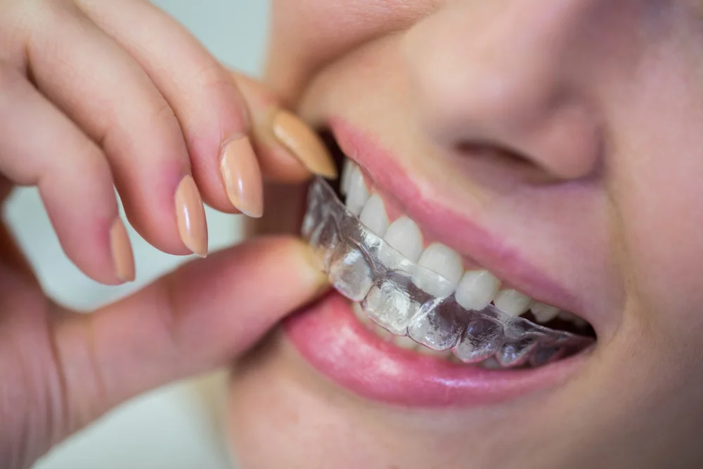 Clear Aligners vs Braces